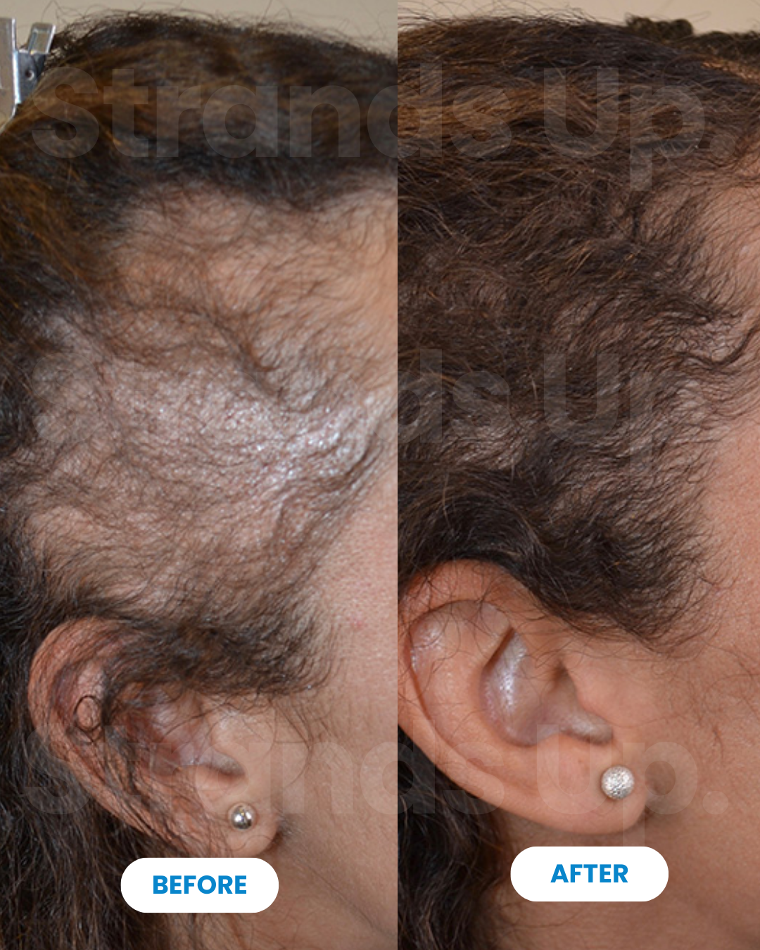 Strands Up - QuadStim™ Roller For Hair Loss