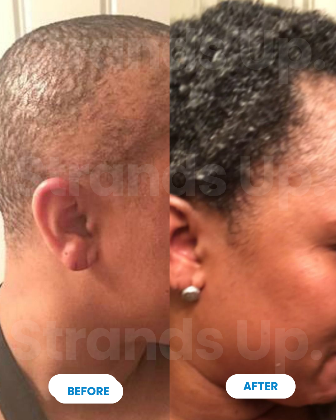 Strands Up - QuadStim™ Roller For Hair Loss