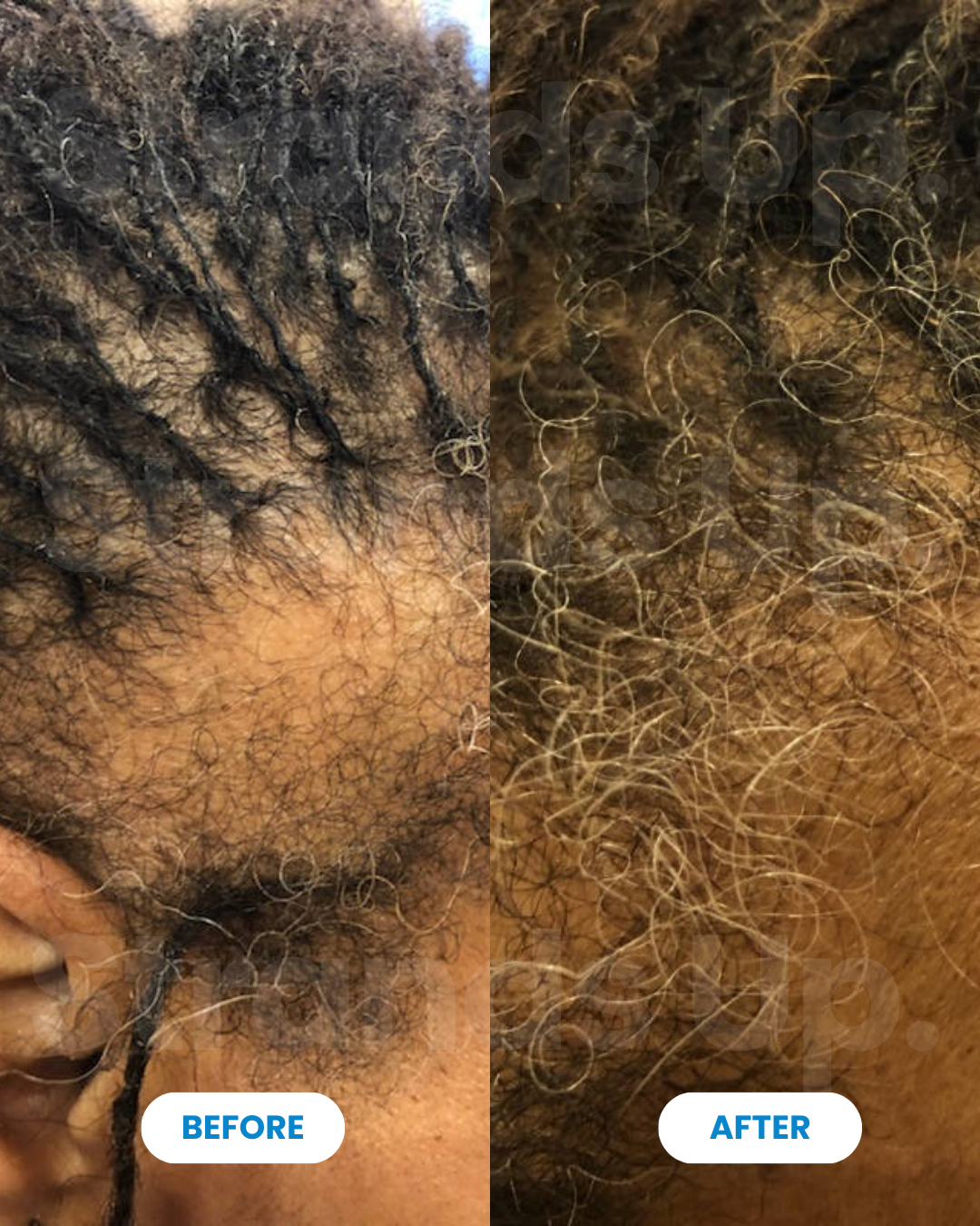 Strands Up - QuadStim™ Roller For Hair Loss