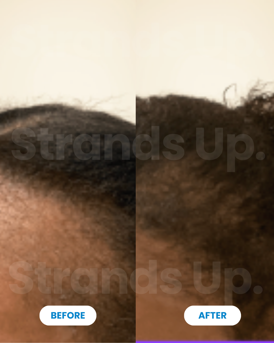 Strands Up - QuadStim™ Roller For Hair Loss